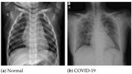 University of the West of Scotland study. X-ray technique found to test for Covid-19 in a few minutes, faster than a PCR test