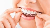 Woman wearing orthodontic silicone aligner. iStock image